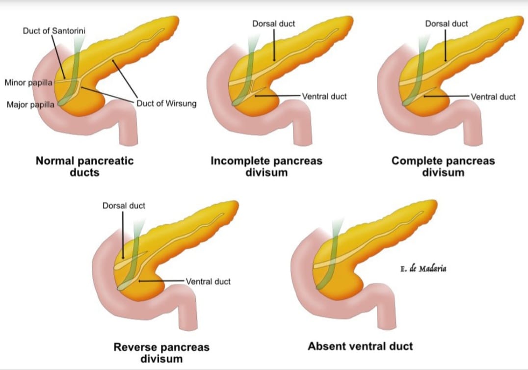 the-main-anatomical-variations-of-the-pancreatic-duct-system